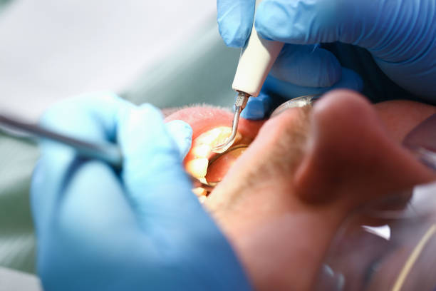 Best Emergency Wisdom Teeth Removal in Richland, PA
